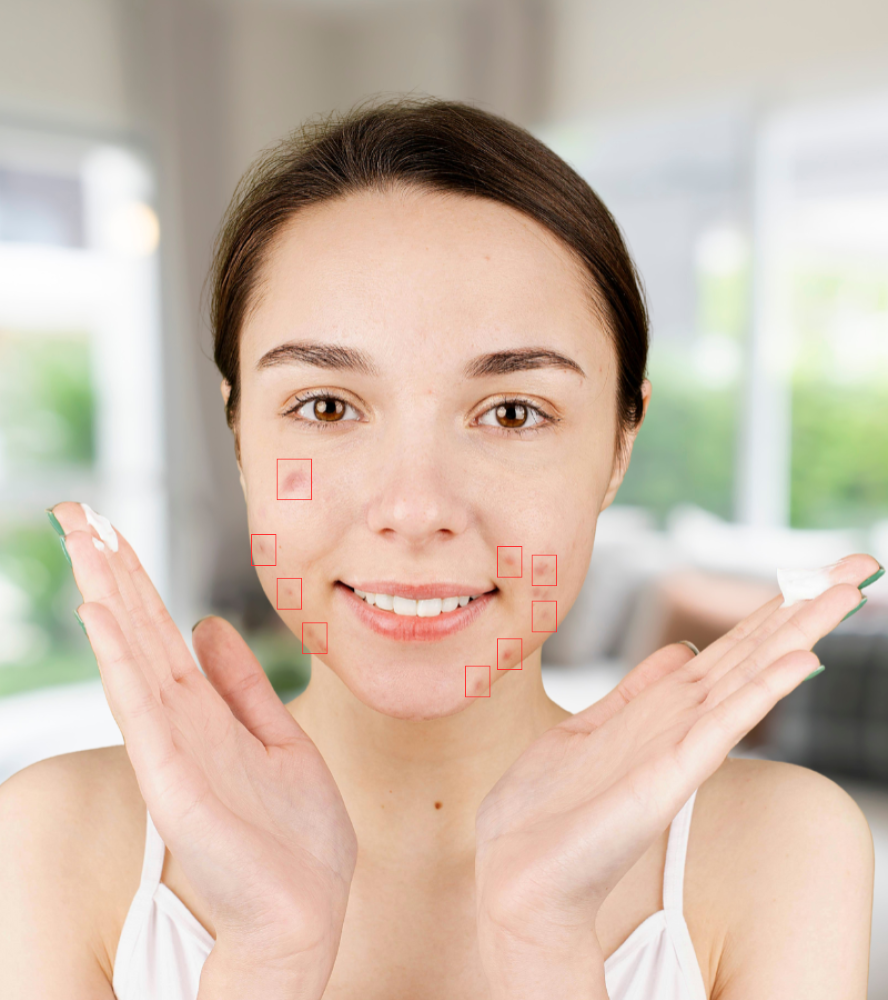 AI Acne Detection